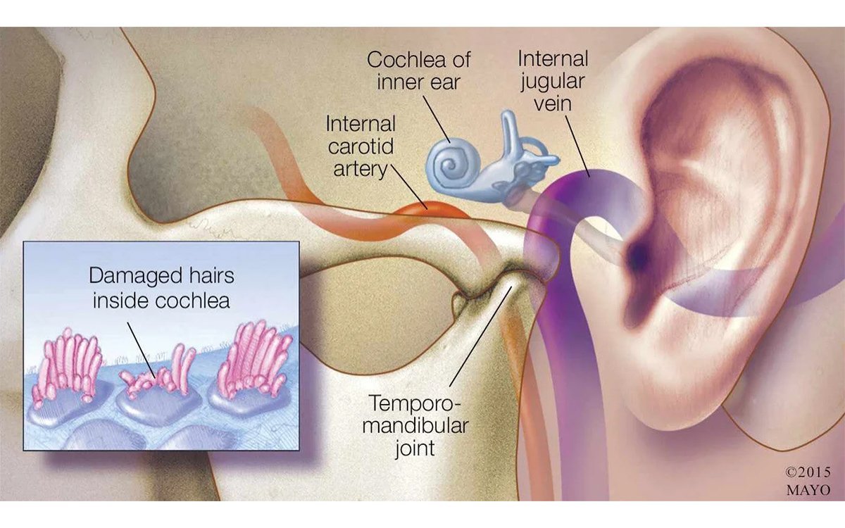 Sensorineural Tinnitus: Causes, Symptoms, and Treatment Options